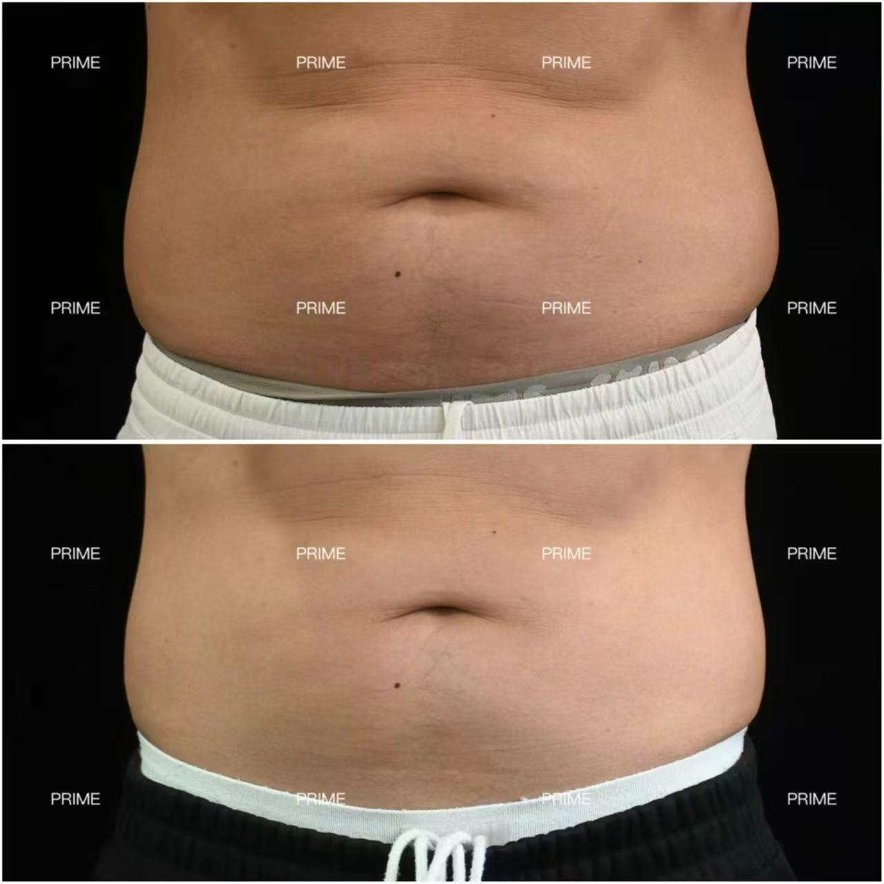 Lipocel before and after abdominal fat reduction result with black pants from Prime Cosmetic Clinic