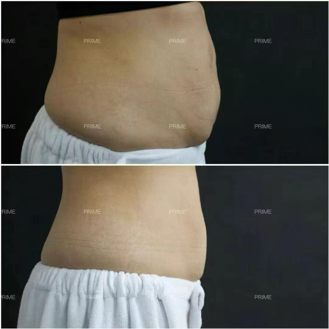 Lipocel before and after abdominal fat reduction result with white pants from Prime Cosmetic Clinic