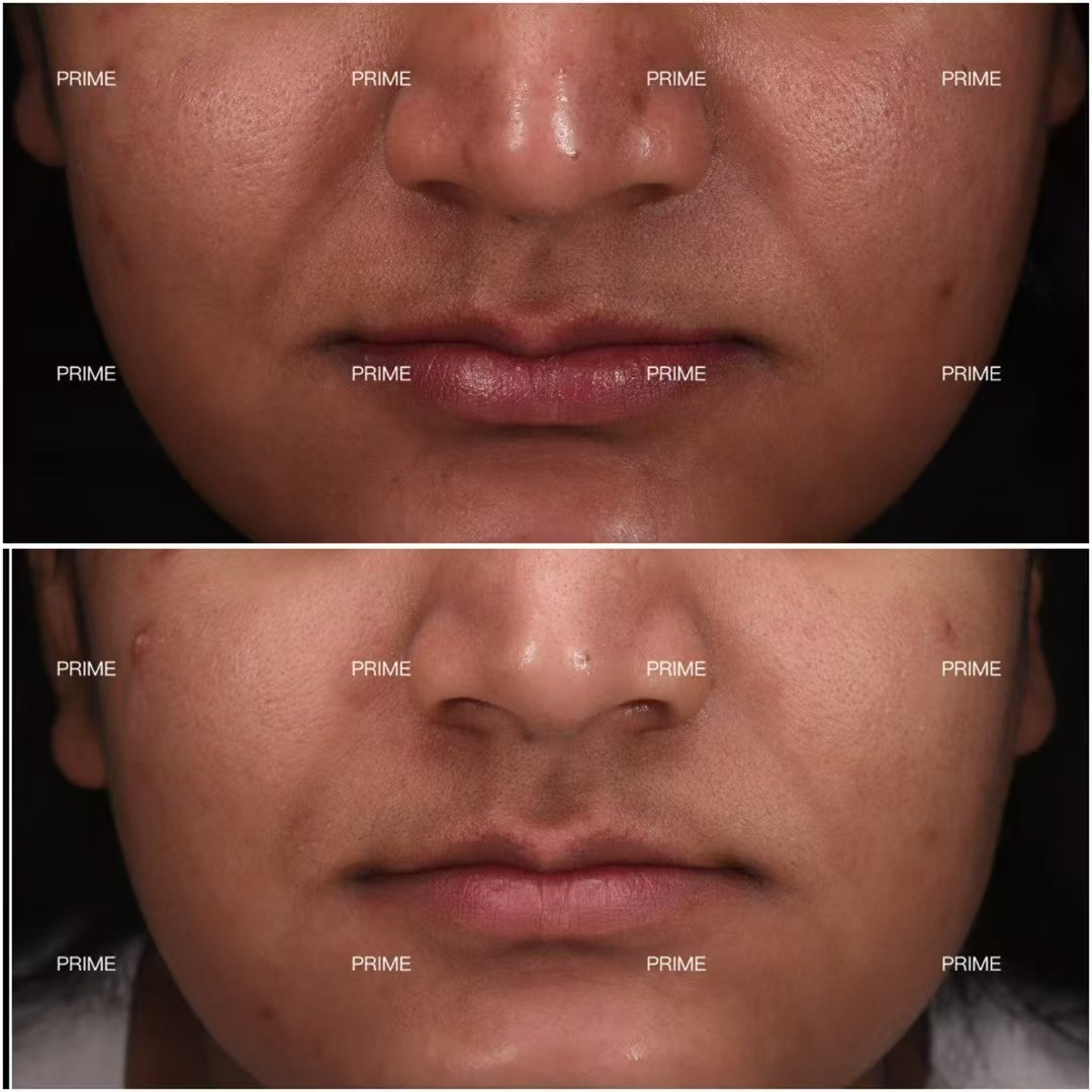 ASCE+ Exosome Therapy related skin texture case