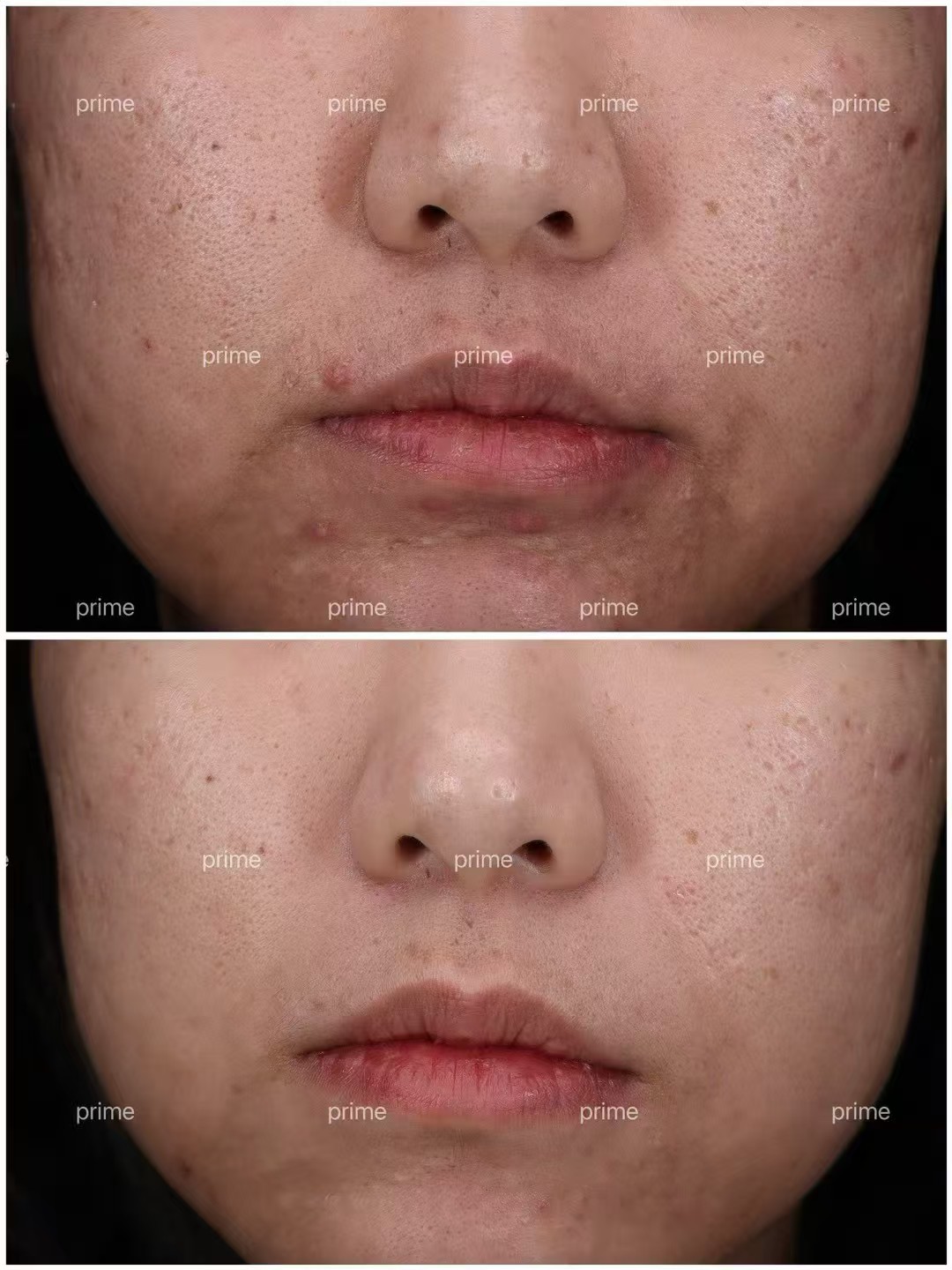 ASCE+ Exosome Therapy related acne recovery case