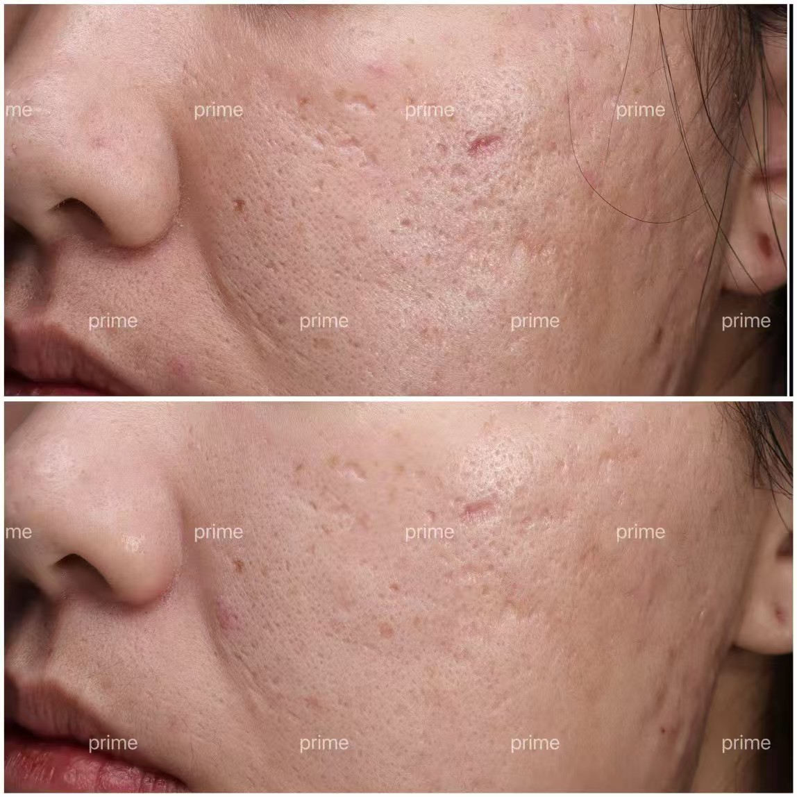 ASCE+ Exosome Therapy related pore and texture case