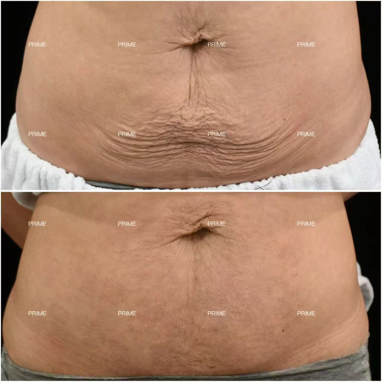 Morpheus8 Body abdomen before and after result from Prime Cosmetic Clinic