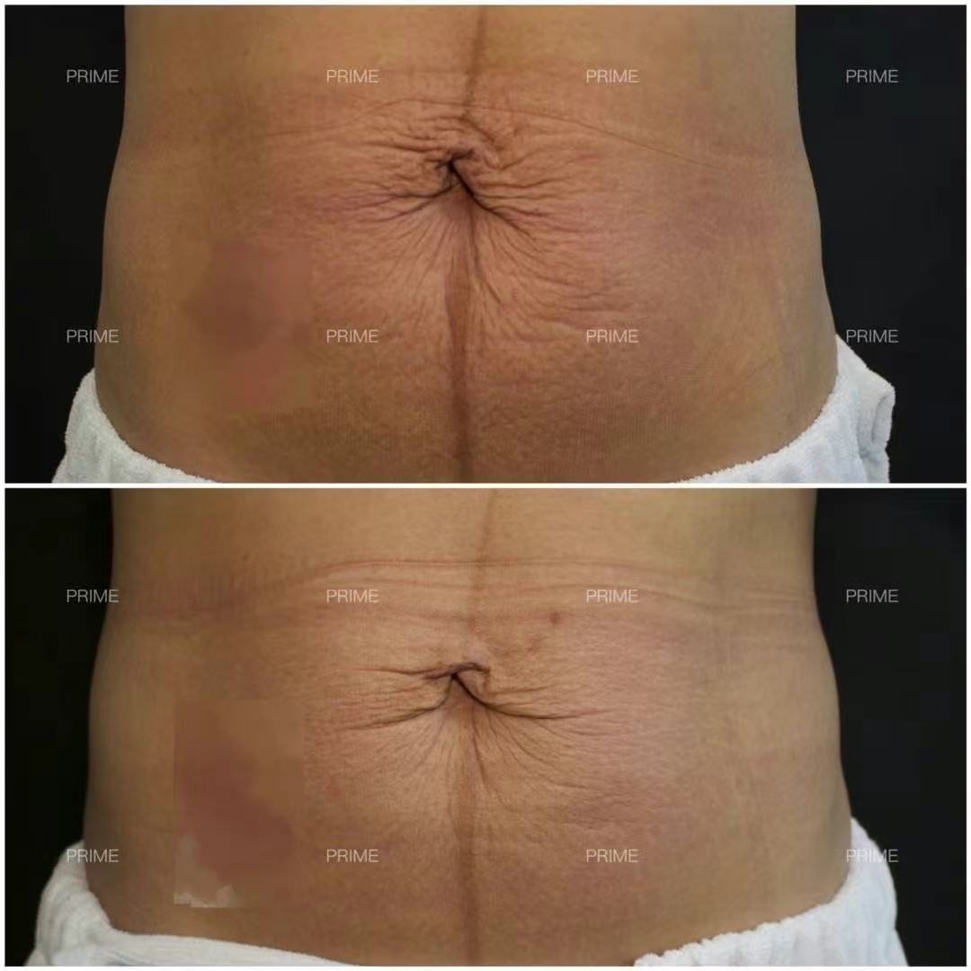 Morpheus8 Body abdominal skin texture before and after result from Prime Cosmetic Clinic