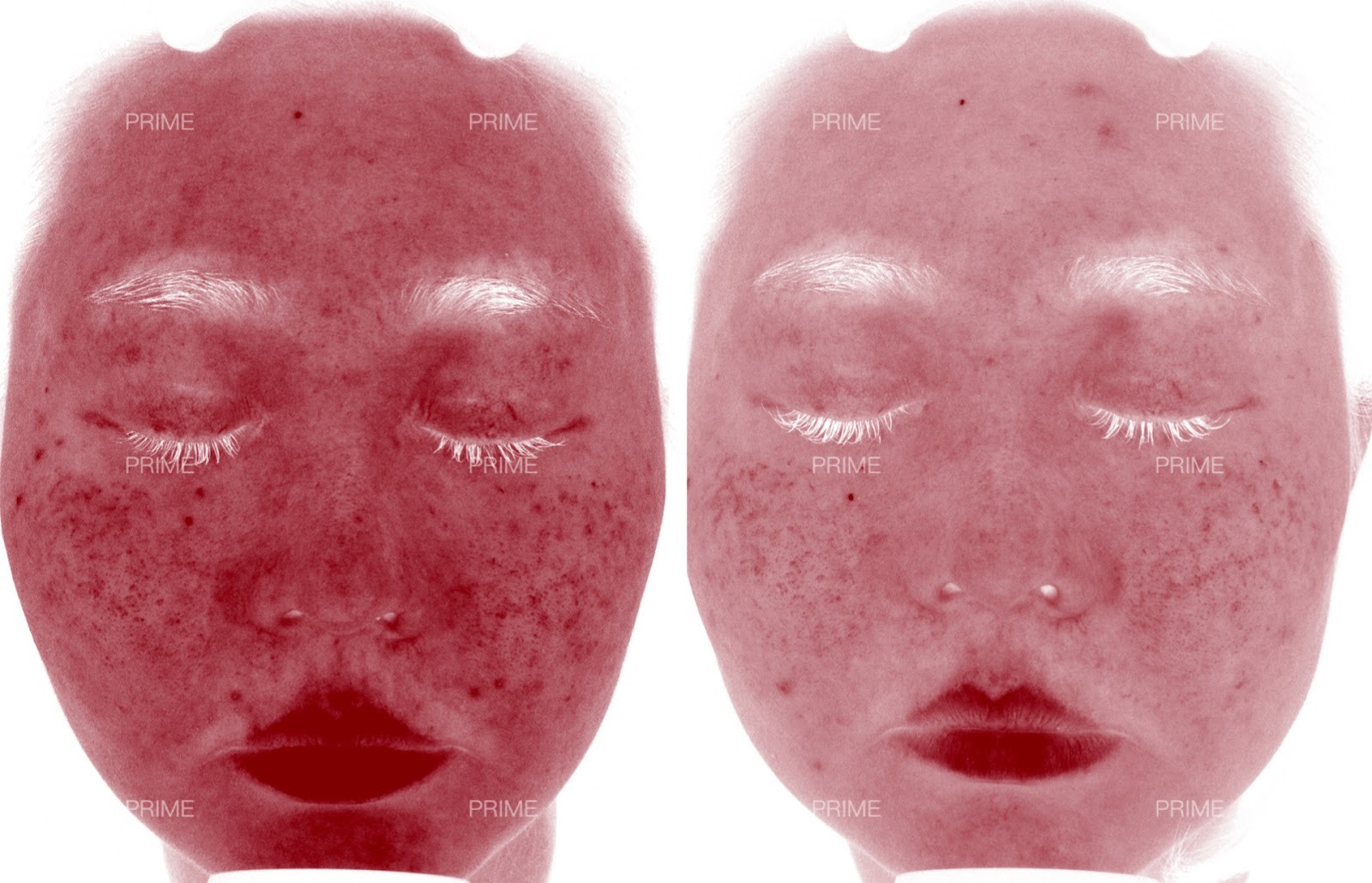 Harmony before and after redness result at Prime Cosmetic Clinic