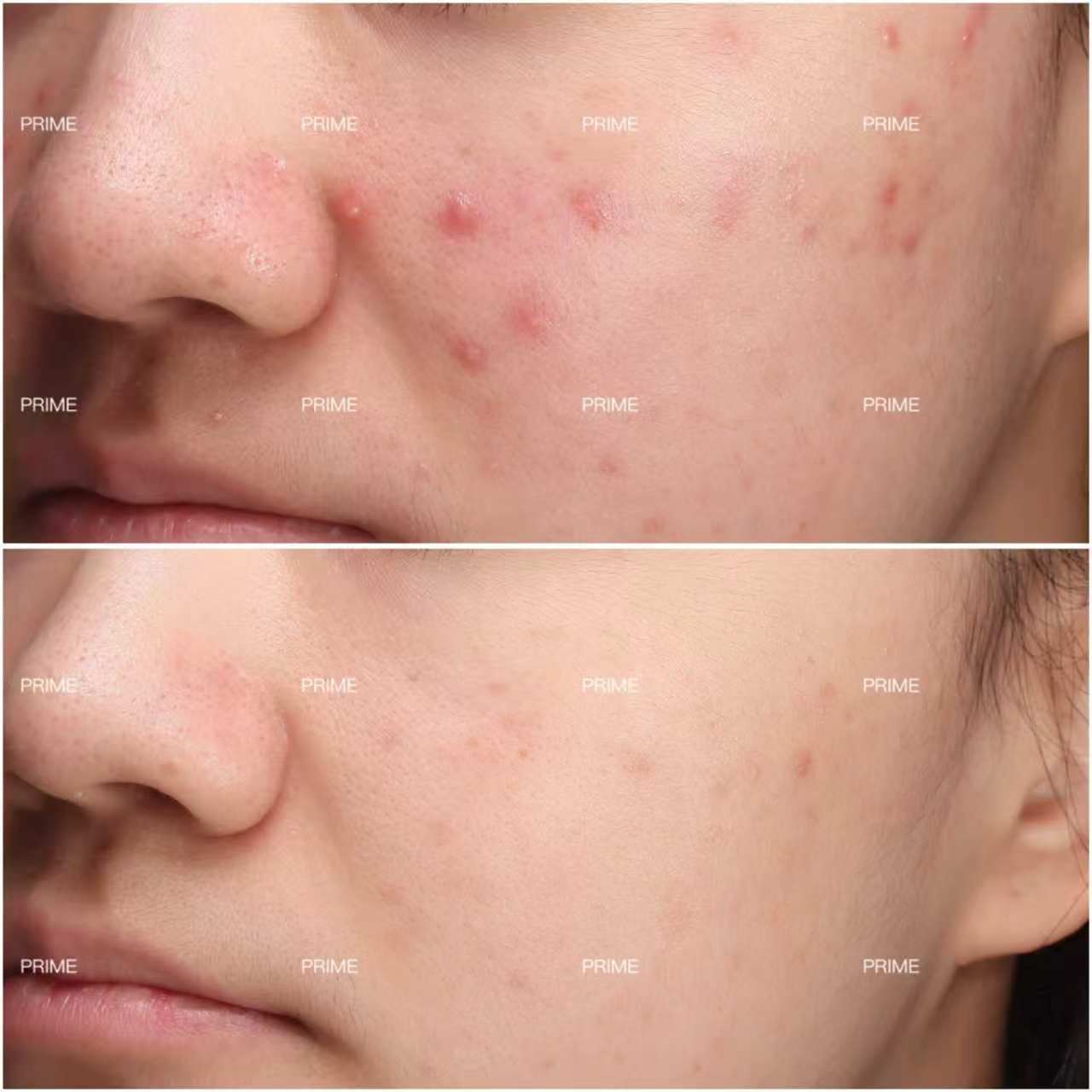 Harmony before and after acne result at Prime Cosmetic Clinic
