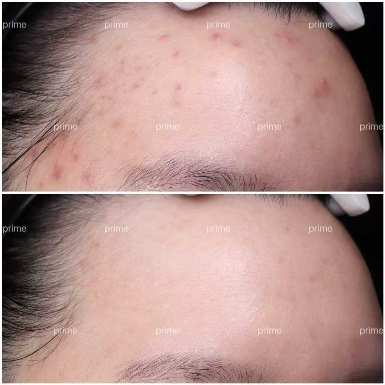 Harmony before and after forehead acne result at Prime Cosmetic Clinic