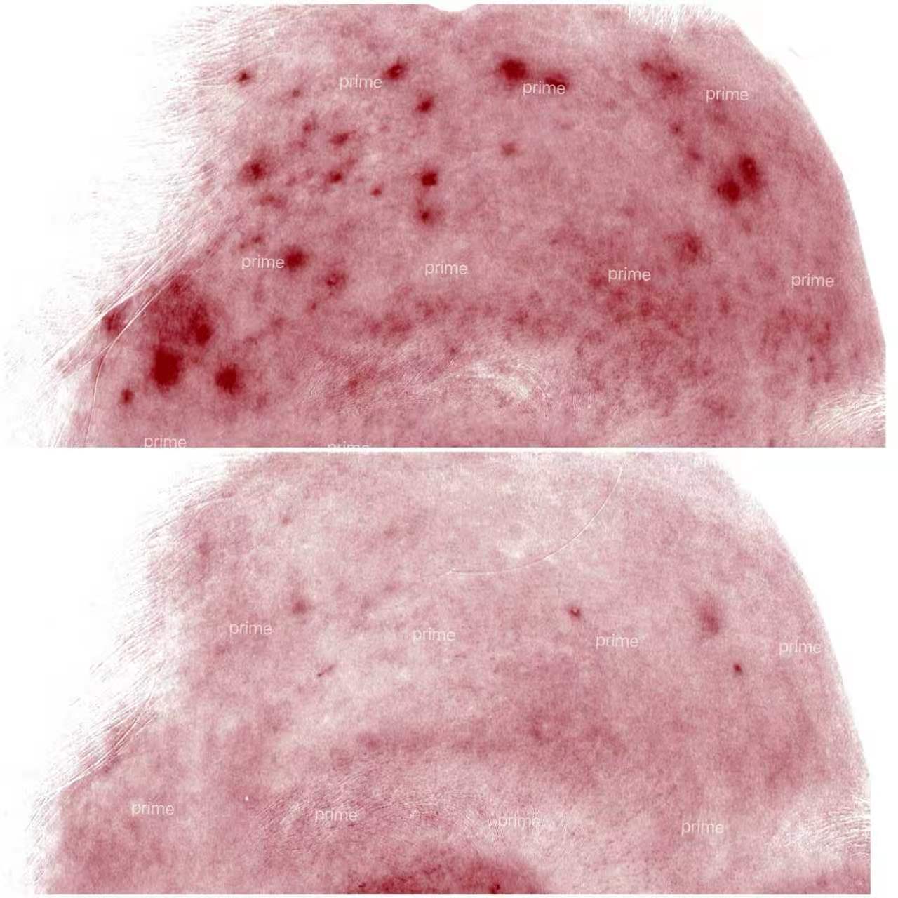 Harmony before and after forehead redness result at Prime Cosmetic Clinic