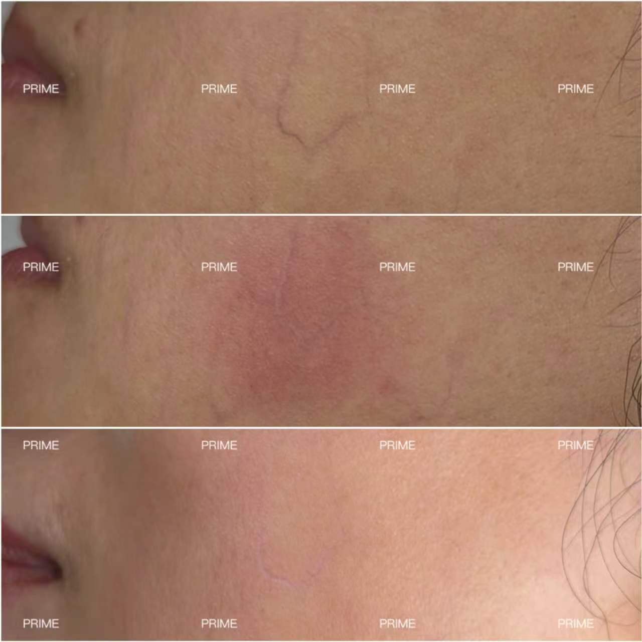 Harmony before and after vascular redness result at Prime Cosmetic Clinic