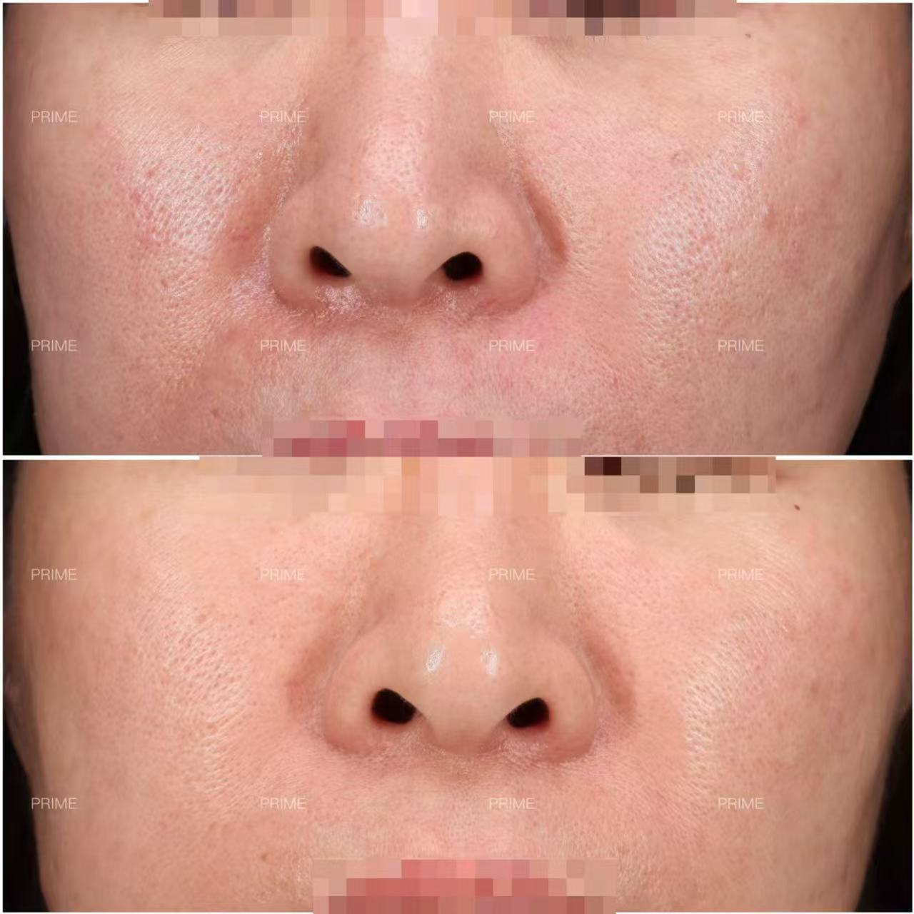 Venus Viva texture refinement before and after result from Prime Cosmetic Clinic
