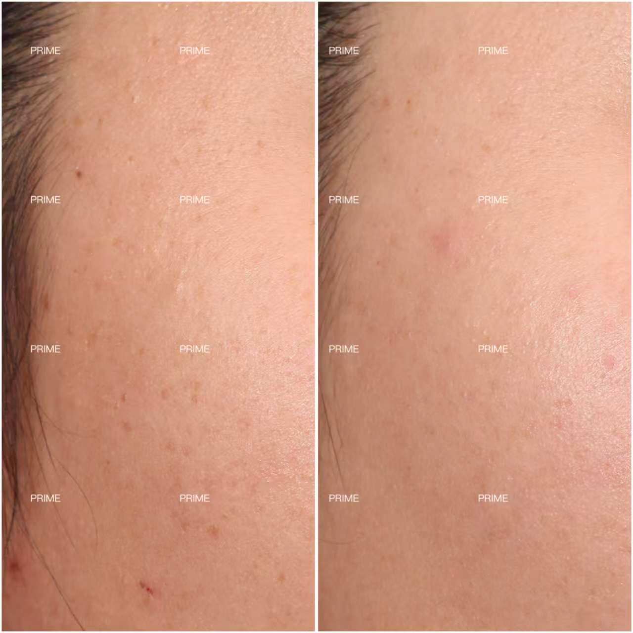 Warts Removal before and after result 01 from Prime Cosmetic Clinic
