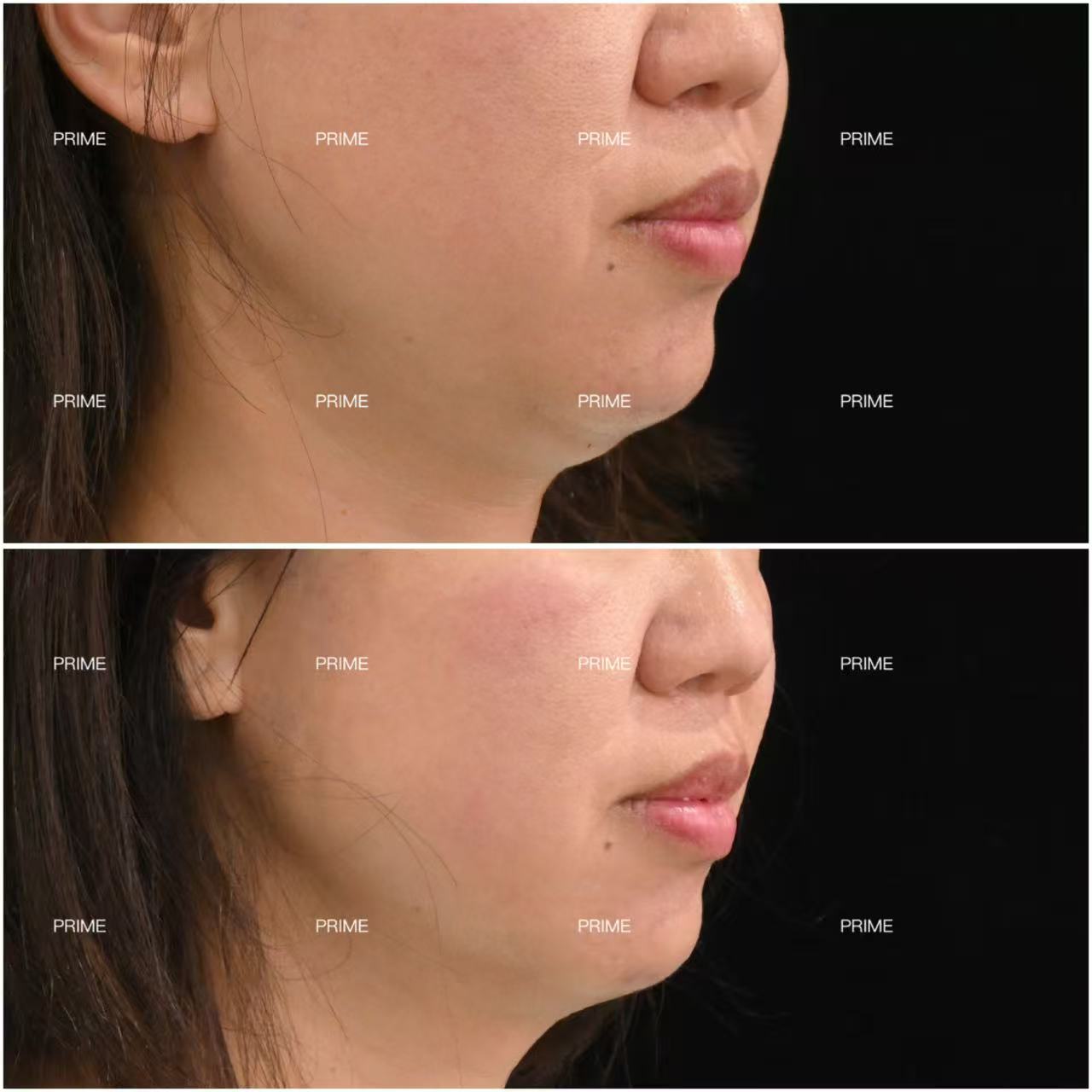 Prime Cosmetic Clinic before and after lower face and chin result