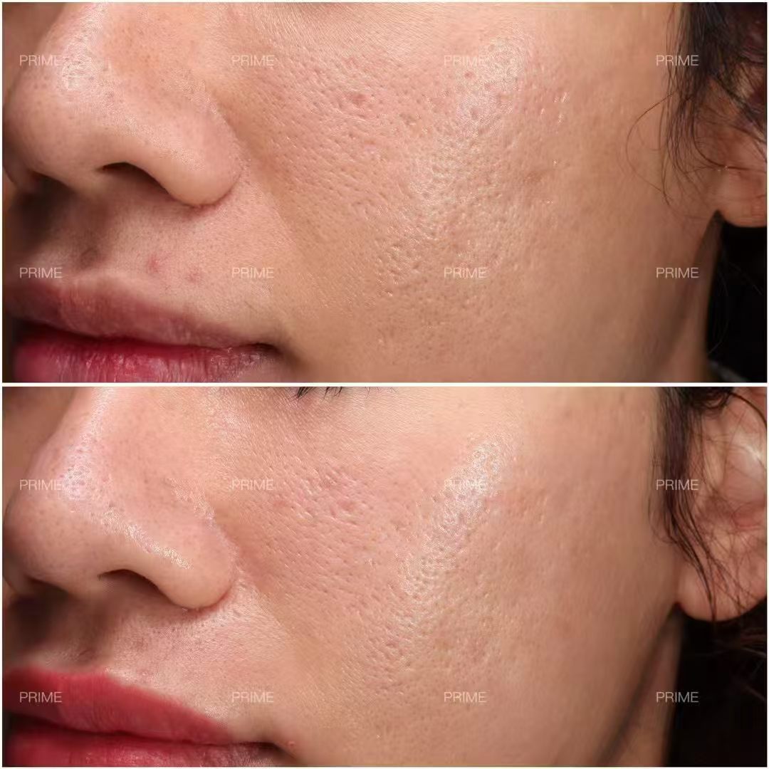 Venus Viva skin texture before and after