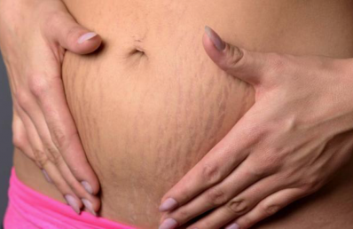 Stretch Marks