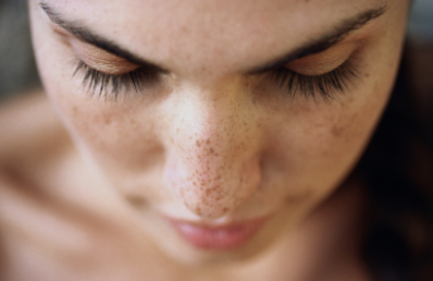 Hyperpigmentation