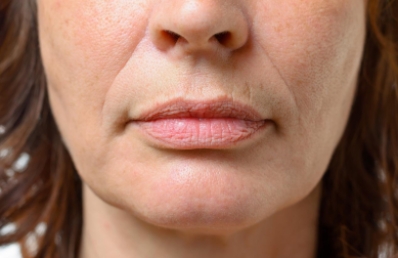 Nasolabial Folds